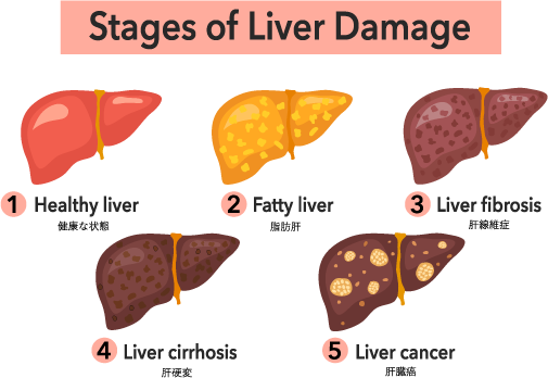 Stages of Liver Damage